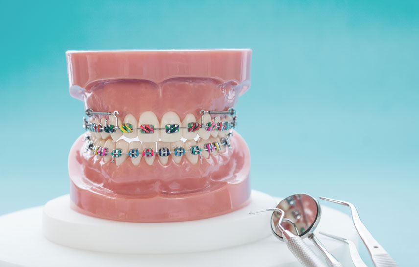 NHS and HSE Braces: How to Access Funded Orthodontic Care