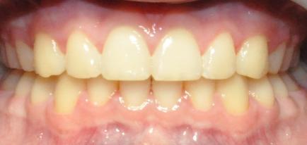 After photo of teeth