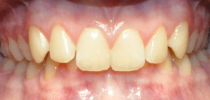 Before photo of teeth